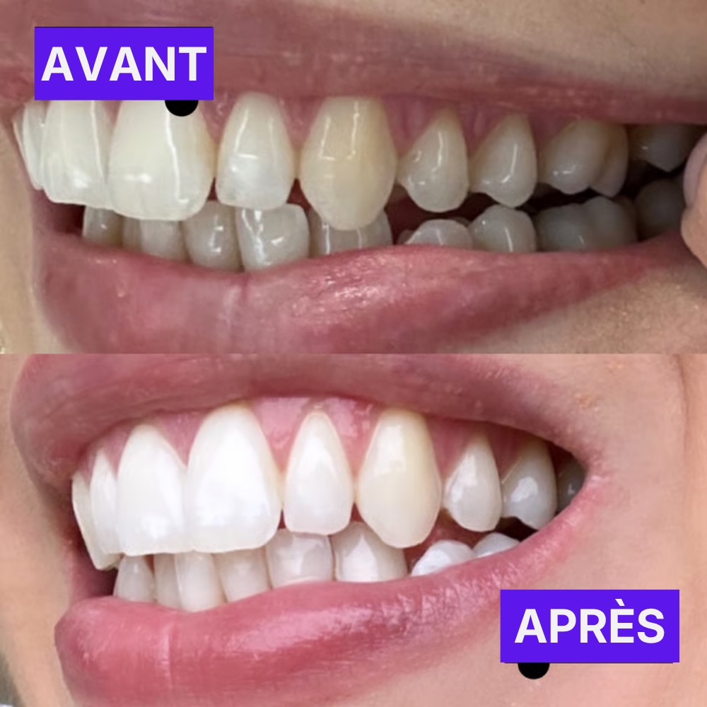 Bandes Blanchissantes Violettes
